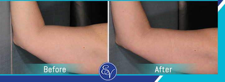 Before and After Photos of Patients of En Vogue Medi-Spa