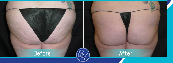 Before and After Photos of Patients of En Vogue Medi-Spa