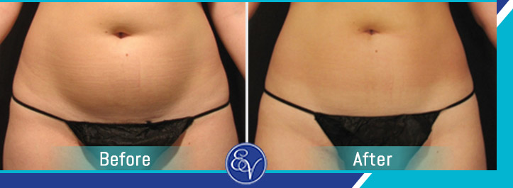 Before and After Photos of Patients of En Vogue Medi-Spa