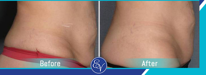 Before and After Photos of Patients of En Vogue Medi-Spa