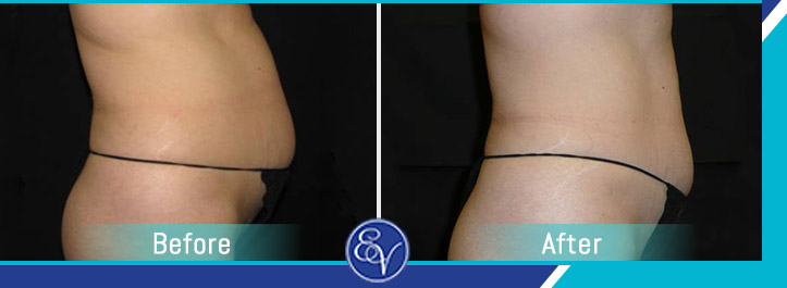 Before and After Photos of Patients of En Vogue Medi-Spa Before and After Photos of Patients of En Vogue Medi-Spa