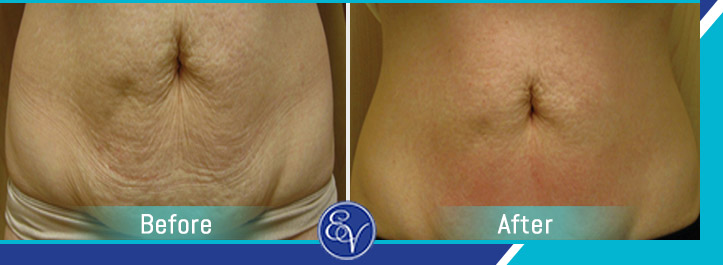 Before and After Photos of Patients of En Vogue Medi-Spa