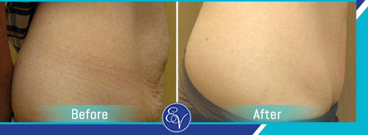 Before and After Photos of Patients of En Vogue Medi-Spa