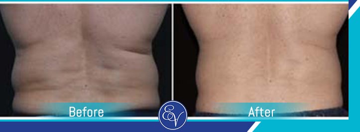 Before and After Photos of Patients of En Vogue Medi-Spa Before and After Photos of Patients of En Vogue Medi-Spa