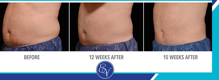 Before and After Photos of Patients of En Vogue Medi-Spa Before and After Photos of Patients of En Vogue Medi-Spa