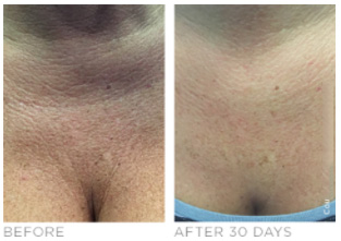 Ultherapy Near Me in Southampton, PA, and Langhorne, PA Ultherapy Near Me in Southampton, PA, and Langhorne, PA