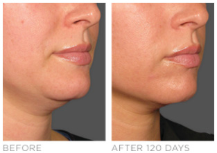 Ultherapy Near Me in Southampton, PA, and Langhorne, PA Ultherapy Near Me in Southampton, PA, and Langhorne, PA