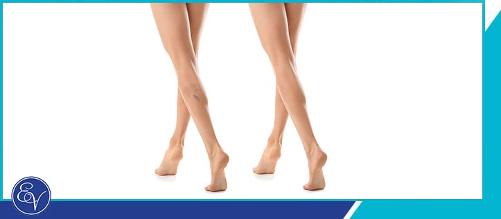 Sclerotherapy Specialist Near Me in Southampton, PA, and Langhorne, PA