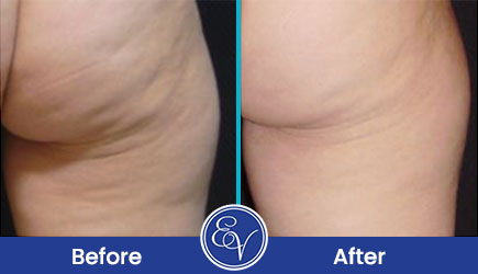 Benefits of Cellulite Treatment with Zimmer ZWave Pro Near Me in Southampton, PA, and Langhorne, PA