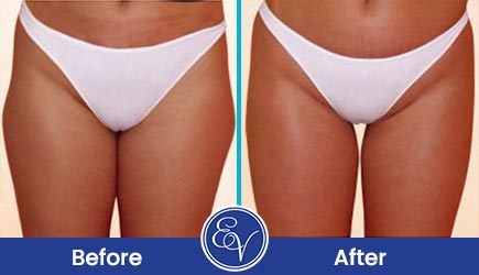 Benefits of Cellulite Treatment with Zimmer ZWave Pro Near Me in Southampton, PA, and Langhorne, PA