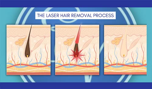 How Does Laser Hair Removal Work Near Me in Southampton, PA, and Langhorne, PA