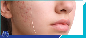 PicoSure Laser Rejuvenation Near Me in Southampton and Langhorne PA PicoSure Laser Rejuvenation Near Me in Southampton and Langhorne PA