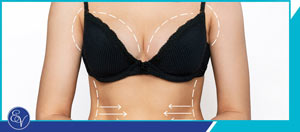 Breast Reduction Surgery Specialist Near Me in Southampton & Langhorne PA