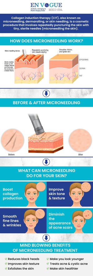 Microneedling is a cosmetic procedure that involves using a device with fine needles to create tiny punctures on the skin’s surface. Rejuvenate your skin with the microneedling treatments offered at En Vogue Medi-Spa. Our staff is committed to providing a higher level of care. Our clinics are located in Southampton, PA, and Langhorne, PA. For more information, contact our friendly staff to schedule a consultation.