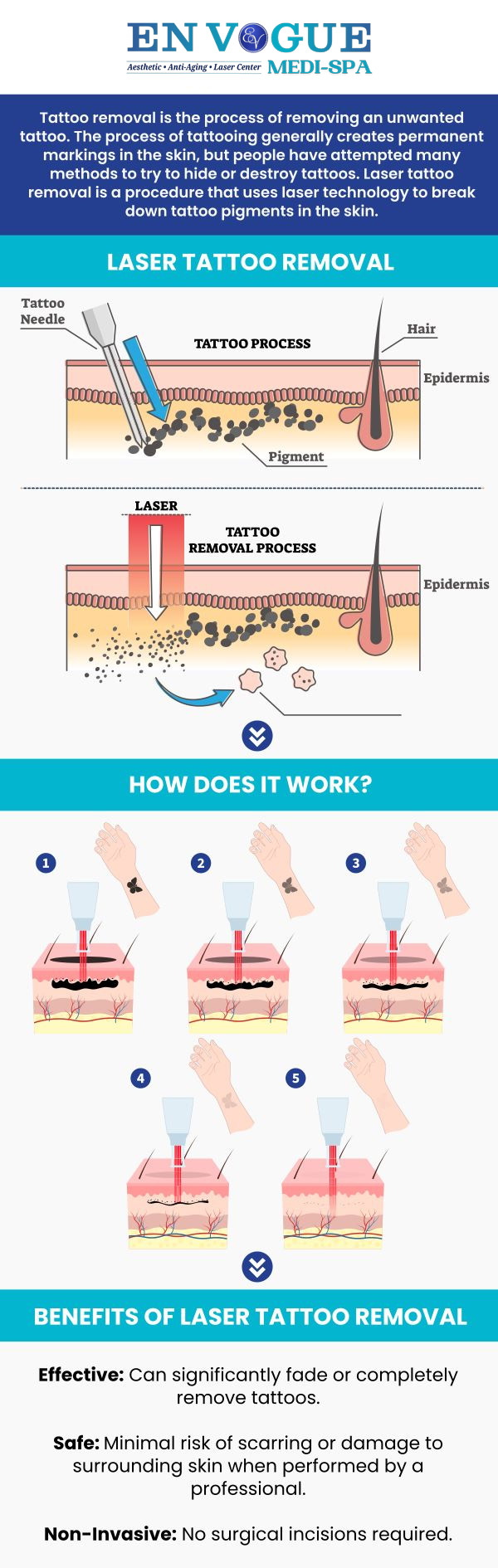Safe and effective laser tattoo removal is available at En Vogue Medi-Spa. We will remove your unwanted tattoo. Please call us for more details or book an appointment online. We have convenient locations to serve you. Safe and effective laser tattoo removal is available at En Vogue Medi-Spa. We will remove your unwanted tattoo. Please call us for more details or book an appointment online. We have convenient locations to serve you.