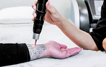 Laser Tattoo Removal at En Vogue Medi-Spa in Southampton, PA and Langhorne, PA