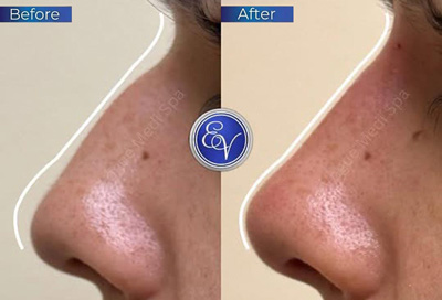 Non-Surgical Nose Correction Before and After Client at En Vogue Medi-Spa in Langhorne, PA