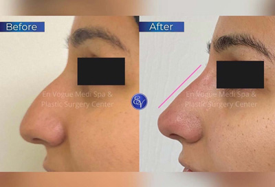 Non-Surgical Nose Correction Before and After Client at En Vogue Medi-Spa in Langhorne, PA