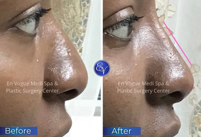 Non-Surgical Nose Correction Before and After Client at En Vogue Medi-Spa in Langhorne, PA